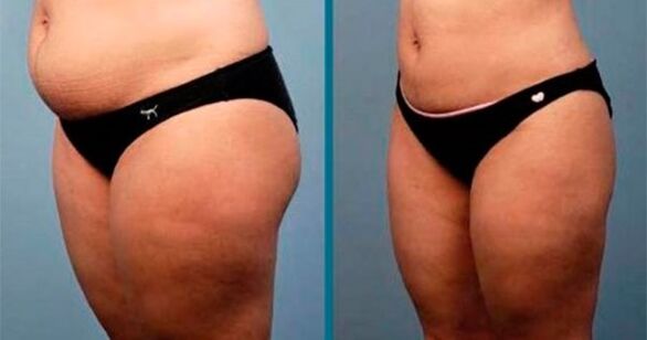 mga pamaagi alang sa pagkawala sa timbang sa 10 ka kilo sa usa ka bulan